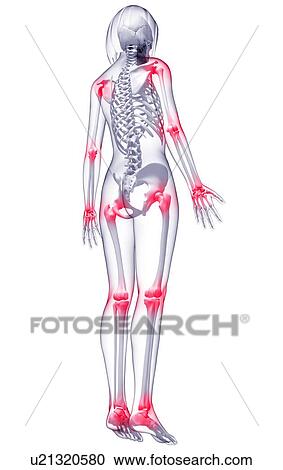 Joint pain, artwork View Large Illustration Clipart - Joint pain, artwork. Fotosearch