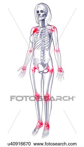 Clipart - Joint pain, artwork. Fotosearch