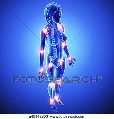 Clipart - Joint pain, artwork. Fotosearch