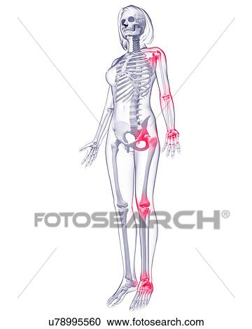 Joint pain, artwork View Large Illustration Clipart - Joint pain, artwork. Fotosearch