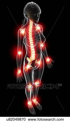 Joint pain, artwork View Large Illustration Clipart - Joint pain, artwork. Fotosearch