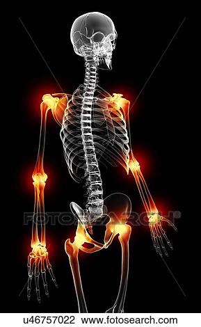 Drawing - Joint pain, artwork. Fotosearch