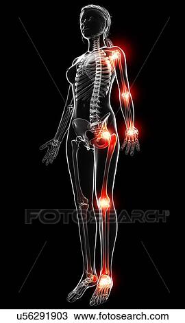 Joint pain, artwork View Large Illustration Drawing - Joint pain, artwork. Fotosearch