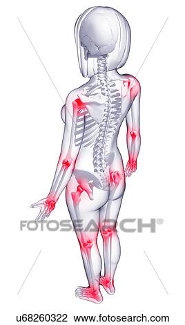 Drawing - Joint pain, artwork. Fotosearch