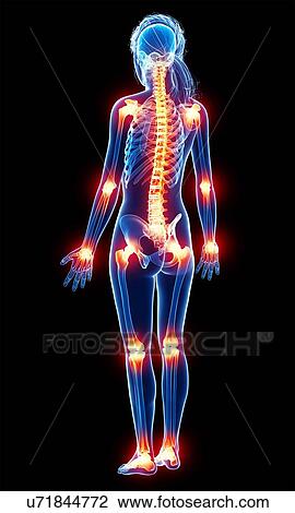 Joint pain, artwork View Large Illustration Drawing - Joint pain, artwork. Fotosearch