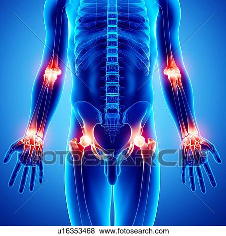 Joint pain, artwork View Large Illustration Stock Illustration - Joint pain, artwork. Fotosearch