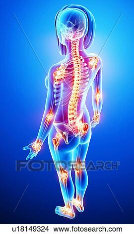 Stock Illustration - Joint pain, artwork. Fotosearch