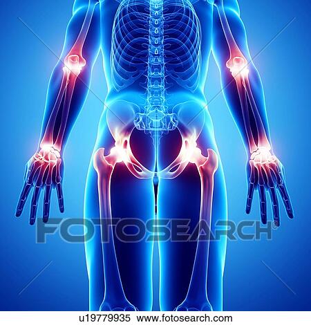 Stock Illustration - Joint pain, artwork. Fotosearch