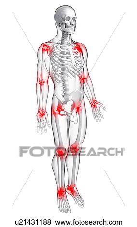 Joint pain, artwork View Large Illustration Stock Illustration - Joint pain, artwork. Fotosearch
