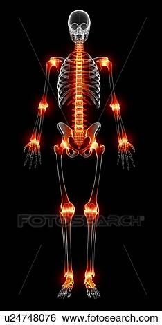 Joint pain, artwork View Large Illustration Stock Illustration - Joint pain, artwork. Fotosearch
