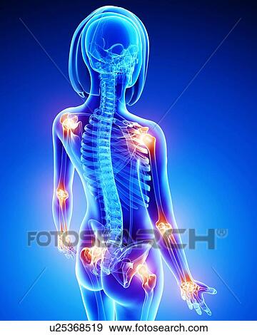 Joint pain, artwork View Large Illustration Stock Illustration - Joint pain, artwork. Fotosearch