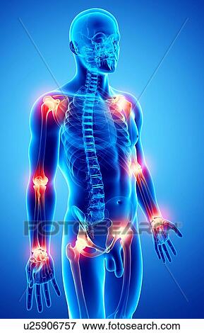 Joint pain, artwork View Large Illustration Stock Illustration - Joint pain, artwork. Fotosearch