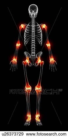 Joint pain, artwork View Large Illustration Stock Illustration - Joint pain, artwork. Fotosearch