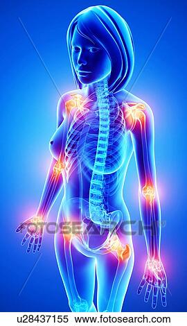Stock Illustration - Joint pain, artwork. Fotosearch