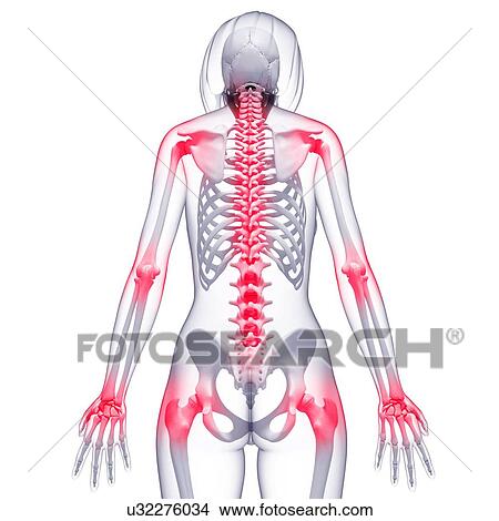 Stock Illustration - Joint pain, artwork. Fotosearch