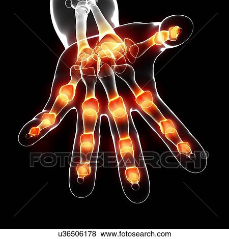 Joint pain, artwork View Large Illustration Stock Illustration - Joint pain, artwork. Fotosearch