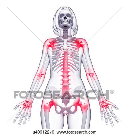 Joint pain, artwork View Large Illustration Stock Illustration - Joint pain, artwork. Fotosearch