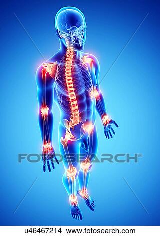 Stock Illustration - Joint pain, artwork. Fotosearch