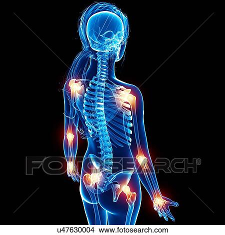 Joint pain, artwork View Large Illustration Stock Illustration - Joint pain, artwork. Fotosearch