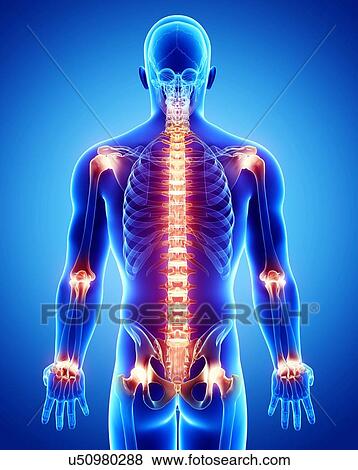 Stock Illustration - Joint pain, artwork. Fotosearch