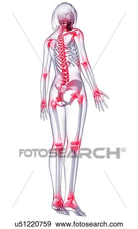 Joint pain, artwork View Large Illustration Stock Illustration - Joint pain, artwork. Fotosearch