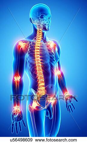 Joint pain, artwork View Large Illustration Stock Illustration - Joint pain, artwork. Fotosearch