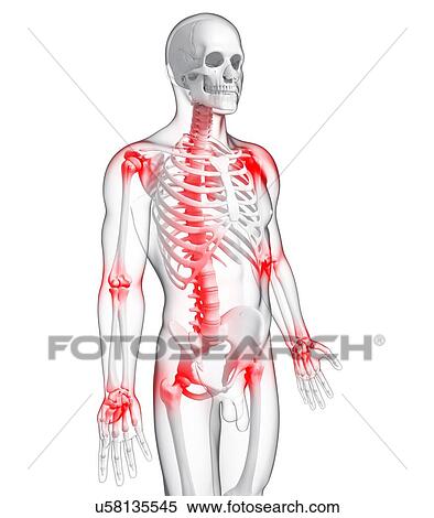 Stock Illustration - Joint pain, artwork. Fotosearch