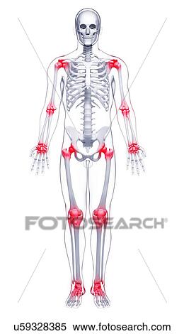 Stock Illustration - Joint pain, artwork. Fotosearch