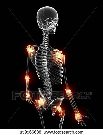 Stock Illustration - Joint pain, artwork. Fotosearch