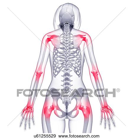 Joint pain, artwork Stock Illustration | u61255529 | Fotosearch