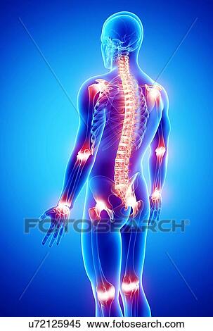 Joint pain, artwork View Large Illustration Stock Illustration - Joint pain, artwork. Fotosearch