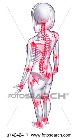 Joint pain, artwork Stock Illustration | u74242417 | Fotosearch