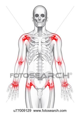Joint pain, artwork View Large Illustration Stock Illustration - Joint pain, artwork. Fotosearch