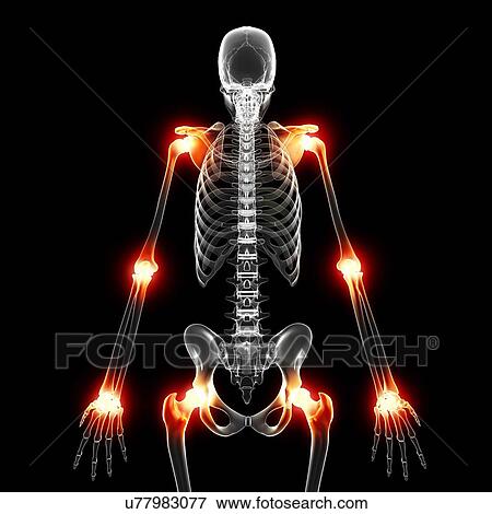 Joint pain, artwork View Large Illustration Stock Illustration - Joint pain, artwork. Fotosearch