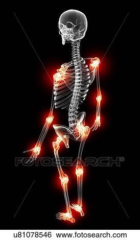 Joint pain, artwork View Large Illustration Stock Illustration - Joint pain, artwork. Fotosearch