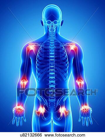 Joint pain, artwork View Large Illustration Stock Illustration - Joint pain, artwork. Fotosearch