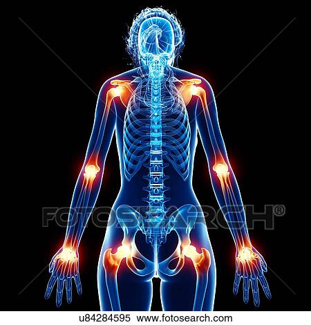 Joint pain, artwork View Large Illustration Stock Illustration - Joint pain, artwork. Fotosearch