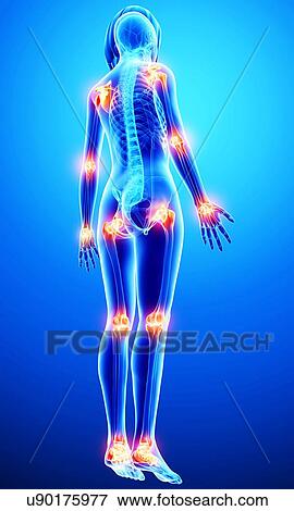 Stock Illustration - Joint pain, artwork. Fotosearch
