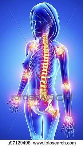Joint pain, artwork View Large Illustration Stock Illustration - Joint pain, artwork. Fotosearch