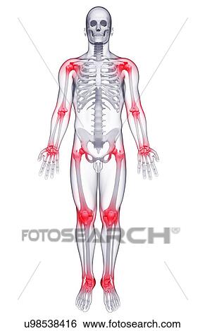 Joint pain, artwork View Large Illustration Stock Illustration - Joint pain, artwork. Fotosearch