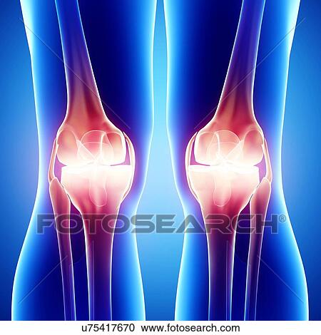 Clipart - Knee pain, artwork. Fotosearch