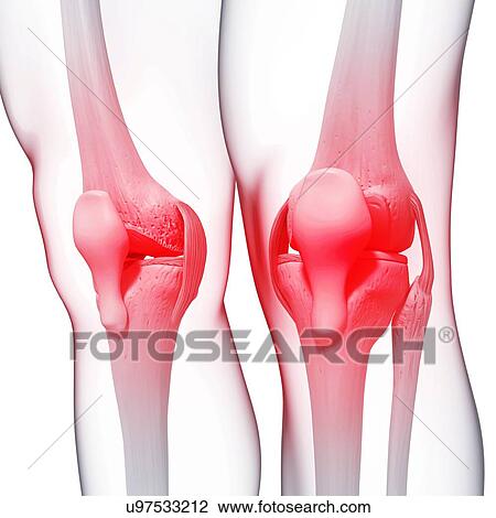 Drawing - Knee pain, artwork. Fotosearch
