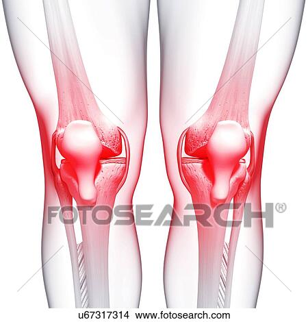Knee pain, artwork View Large Illustration Stock Illustration - Knee pain, artwork. Fotosearch