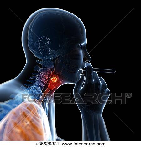 Larynx cancer, artwork View Large Illustration Clip Art - Larynx cancer, artwork. Fotosearch