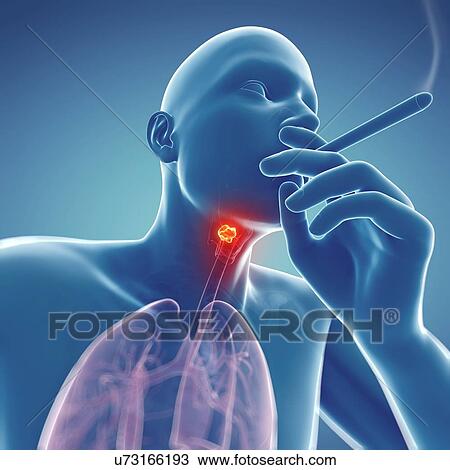Drawing - Larynx cancer, artwork. Fotosearch