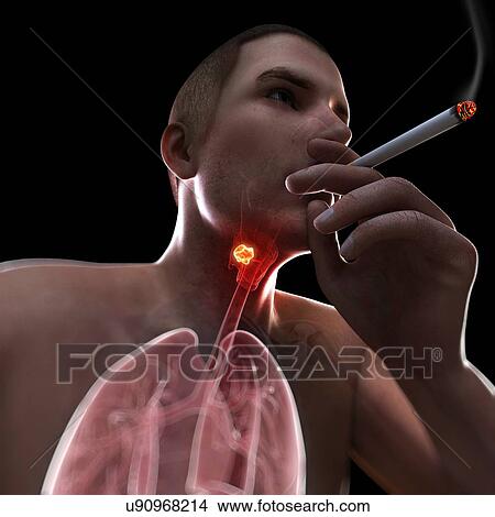 Stock Illustration - Larynx cancer, artwork. Fotosearch