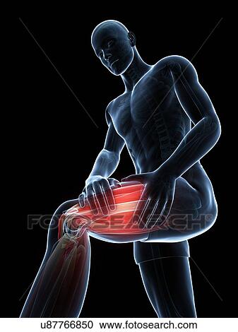 Leg cramp, artwork View Large Illustration Clipart - Leg cramp, artwork. Fotosearch
