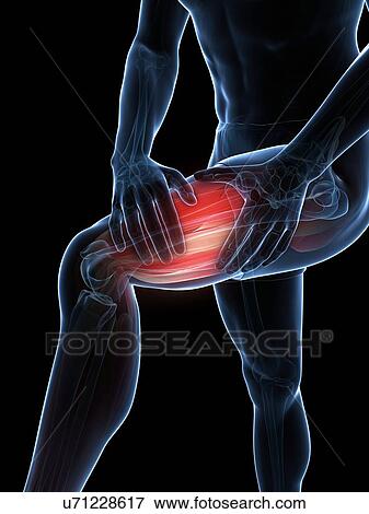Stock Illustration - Leg cramp, artwork. Fotosearch