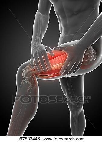 Leg cramp, artwork View Large Illustration Stock Illustration - Leg cramp, artwork. Fotosearch