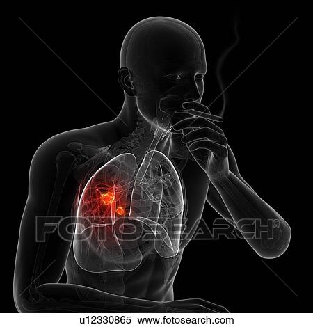 Lung cancer due to smoking, artwork View Large Illustration Stock Illustration - Lung cancer due to smoking, artwork. Fotosearch